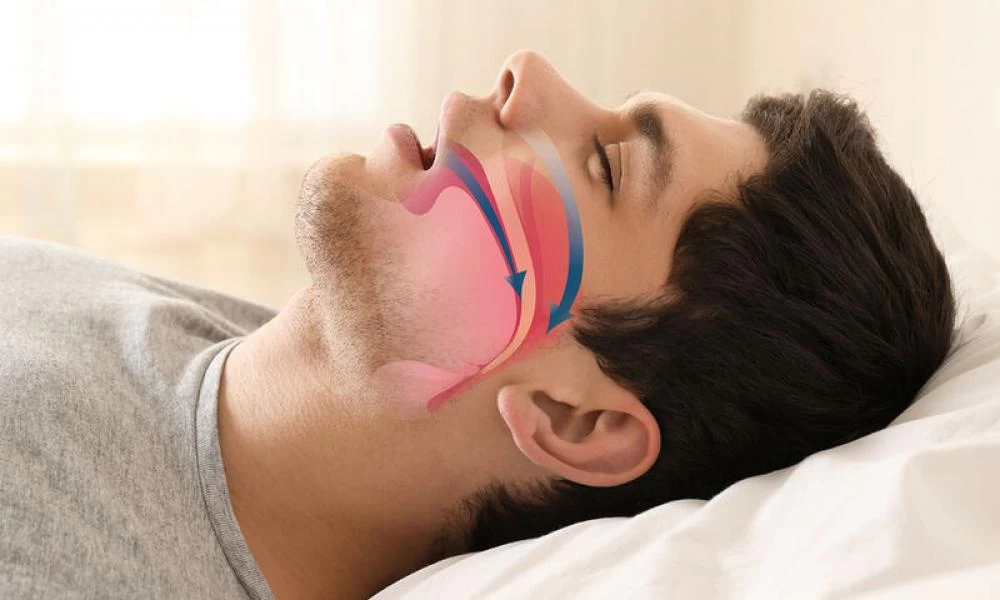 Υπνική άπνοια: Η χρήσιμη μάσκα μειώνει το ροχαλητό